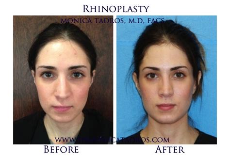 Rhinoplasty Surgeon In Nj Nose Job Surgery Englewood Nj