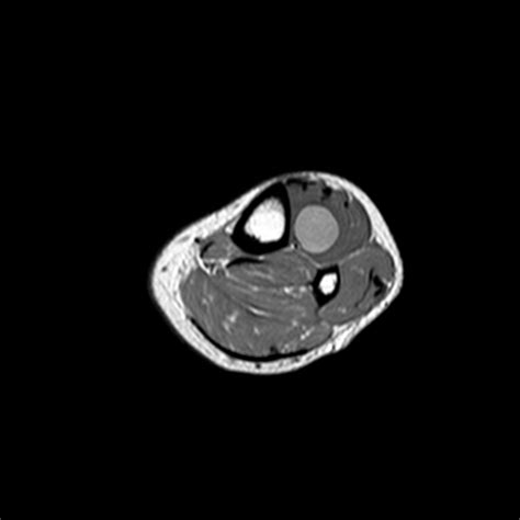 Schwannoma Of The Peroneal Nerve Eurorad