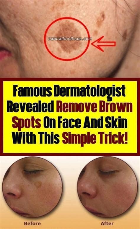 Remove Brown Spots On Face And Skin With This Simple Trick Remove Brown Spot