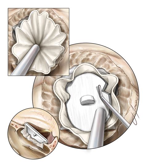 Endoscopic Expanded Transnasal Approach The Neurosurgical Atlas