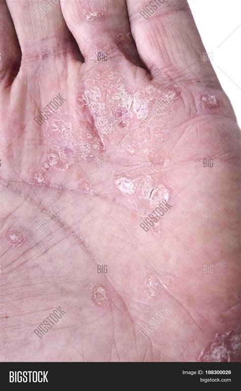 Psoriasis Skin Disease Image And Photo Free Trial Bigstock