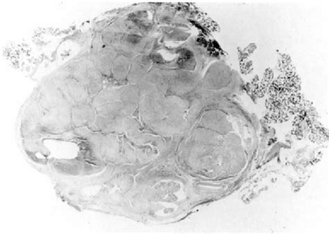Figure 1 From Toxoplasmosis Lymphadenitis Occurring In A Parotid Gland