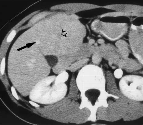 Ct And Mr Imaging Of Benign Hepatic And Biliary Tumors Radiographics