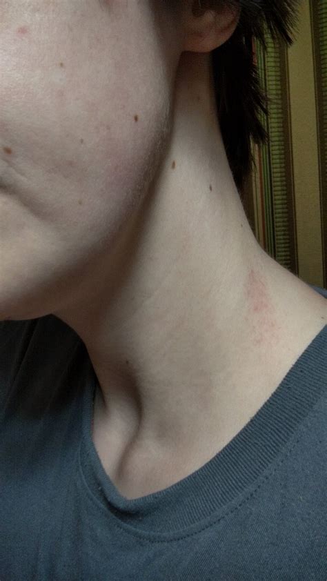 Skin Concerns Ive Had An Itchy Bumpy Rash On My Neck For About 3