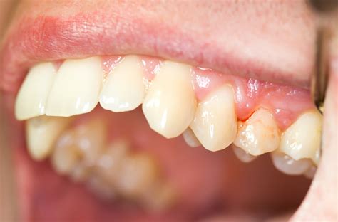 Common Causes Of Bleeding Gums Paducah Dentist