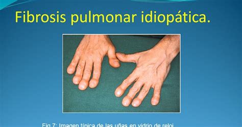 Fibrosis Pulmonar Idiop Tica