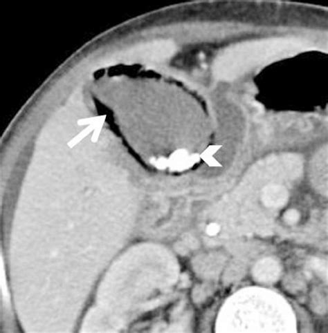Axial Ct Scan Shows Intramural Air In The Gall Bladder Arrow With