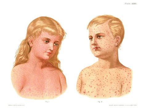 German Measles As Related To Measles Pictures