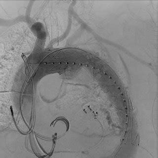 Angiogram Showing Left Persistent Sciatic Artery PSA Aneurysm D