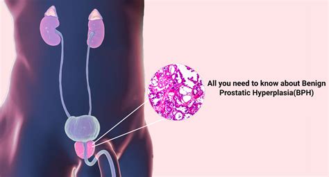 All You Need To Know About Benign Prostatic Hyperplasia BPH Eternal