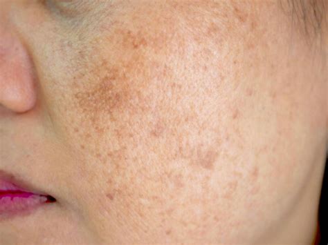 Close Up Of Womans Face With Melasma