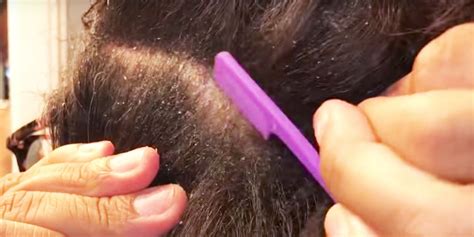 Normal hair loss is due to weak or damaged follicles, with a larger number of hairs than normal in the shedding phase. Top Does Cutting Hair Help Dandruff - Jblogs