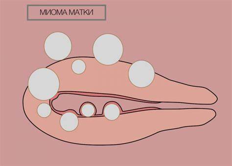 Миома матки и возможности ее лечения — JV klīnika Картинка - Миома матки и возможности ее лечения — JV klīnika