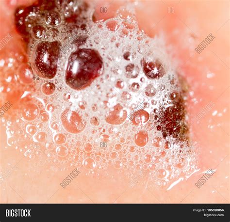 Wound On Human Skin Image And Photo Free Trial Bigstock