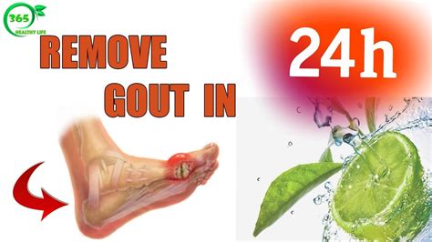 Gout Treatment How To Massage For Feet To Remove Gout In 24h Healthy
