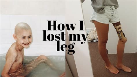 How I Lost My Leg From 9 Year Old Kid To Cancer To Amputee Youtube