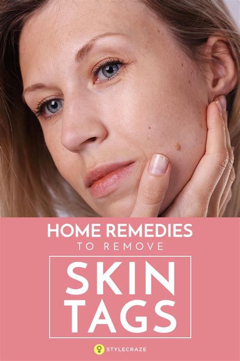 12 Effective Home Remedies To Remove Skin Tags Skin Tag Removal