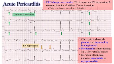 Acute Pericarditis ECG Changes