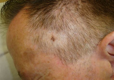 Melanoma On Scalp Pictures Early Stage 1 Scalp Melanoma Images