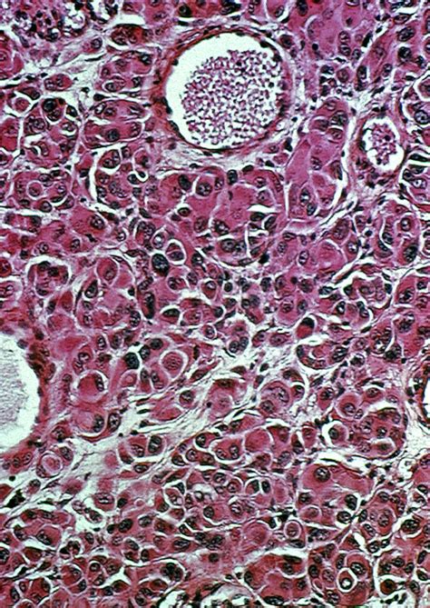 Melanoma Histology Stock Image C0040294 Science Photo Library