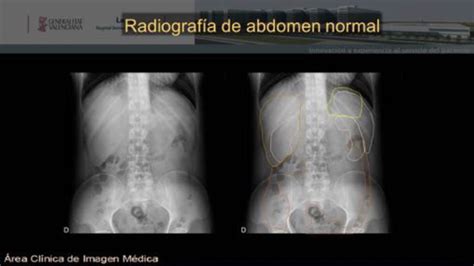 RadiografÍa Simple De Abdomen Seram