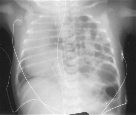 Congenital Diaphragmatic Hernia The Surgeons Perspective Neoreviews