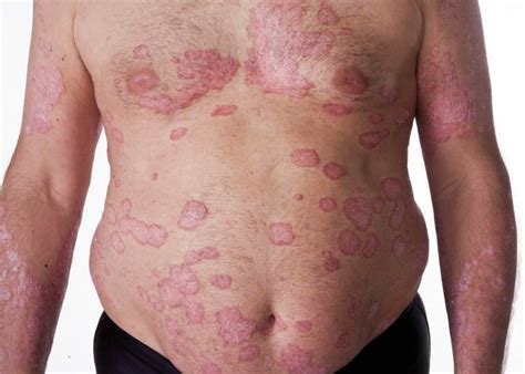 What Triggers Psoriasis And Causes It To Flare