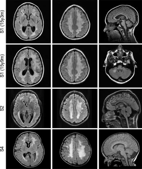 Brain Magnetic Resonance Imaging Mri For Subjects S1 S2 And S4 Brain