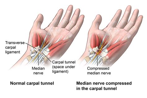 Carpal Tunnel Syndrome Local Physio