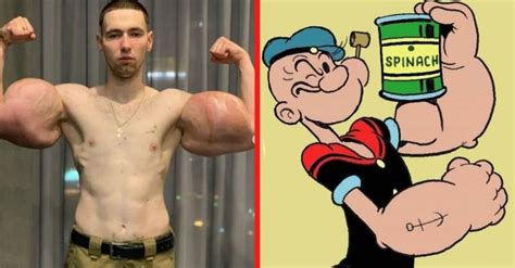 This Real Life Popeye Has 3 Lbs Of Dead Muscle Removed From Biceps