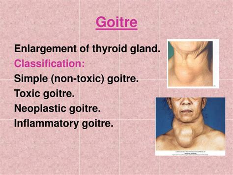 Ppt Benign Thyroid Disorders Powerpoint Presentation Free Download