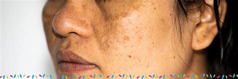 Skin Discoloration And Hyperpigmentation Treatments In Phoenix Az