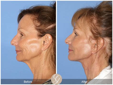 Neck Lift 411 Before After Photos Orange County