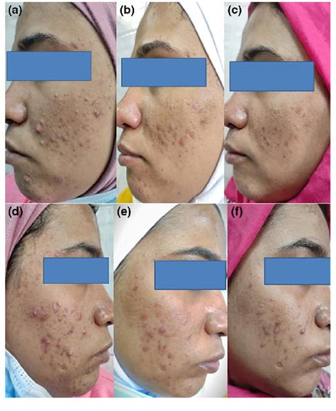 24 Years Old Female Patient With Moderate Inflammatory Acne Iga Score