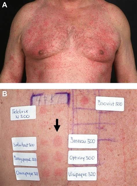 Adverse Reactions During Procedures Annals Of Allergy Asthma