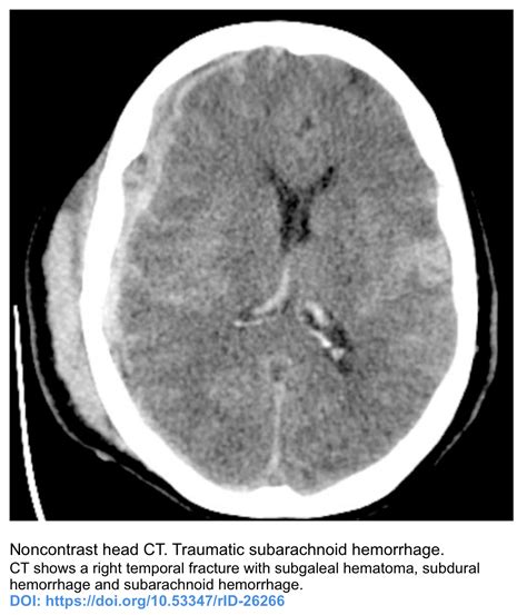 Traumatic Subarachnoid Hemorrhage