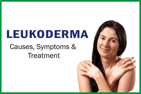 What Is Leucodermavitiligo Causes Symptoms And Treatment In Ayurveda