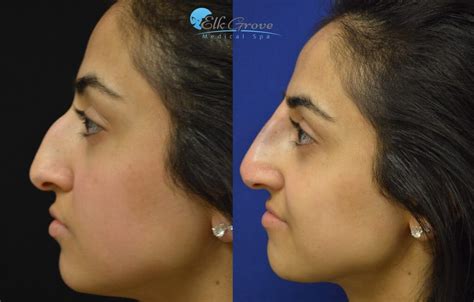Knowing your options when considering a rhinoplasty is important. Non-Surgical Rhinoplasty Sacramento | Nose Job Sacramento