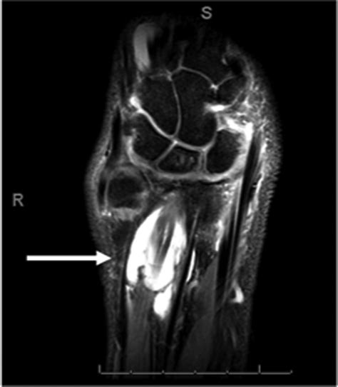 Wrist Extensor Tenosynovitis After Covid 19 Vaccination Journal Of