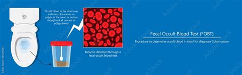 Fecal Occult Blood Test Fobt Lab Stool Sample Bleeding Screen Risk