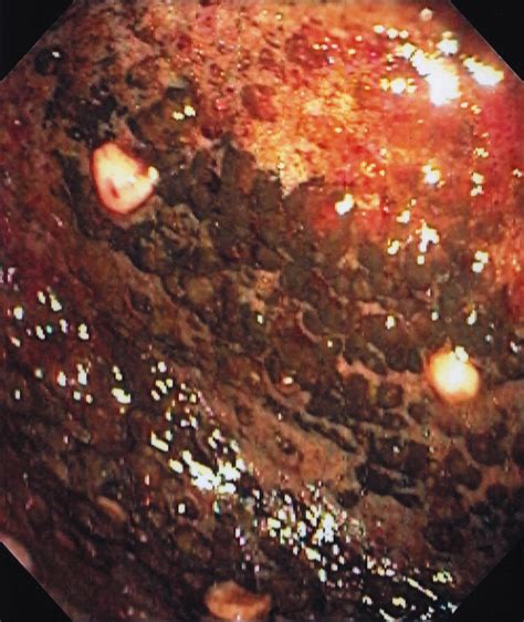 Emphysematous Gastritis Caused By Sarcina Ventriculi Gastrointestinal Endoscopy