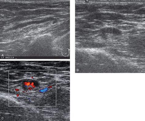 Local Staging Imaging Options And Core Biopsy Strategies Radiology Key
