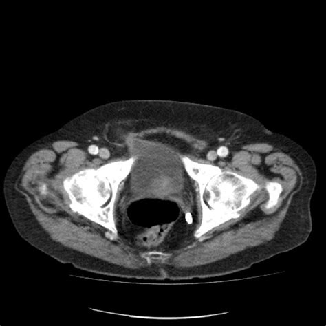 Inguinal Hernia Containing Urinary Bladder Radiology Case