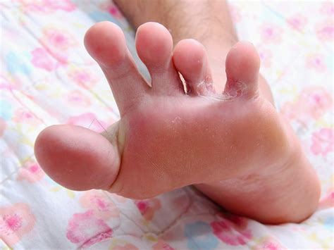 Childhood Rashes And Skin Conditions Photos Babycenter India