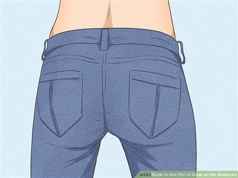 7 Ways To Get Rid Of Acne On The Buttocks Wikihow