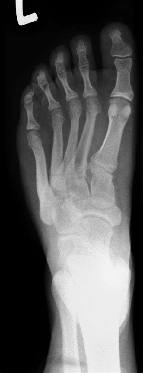 Stress Fracture Of 4th Metatarsal Image