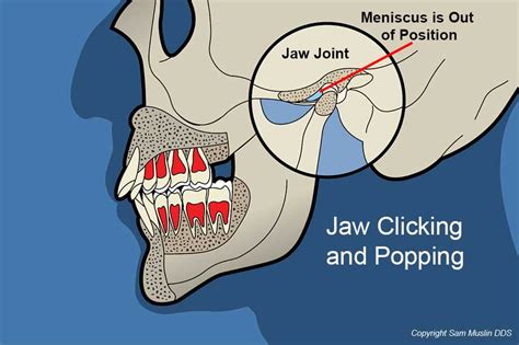 Does Jaw Clicking And Popping Mean I Have Tmj Tmj Dentist Explains