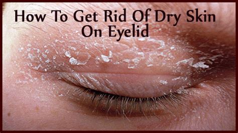 5 Ways To Relieve Dry Skin On Eyelids Naturally In No Time