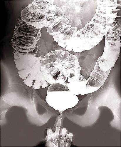 Image Gallery Normal Cervical Mri Sexiz Pix