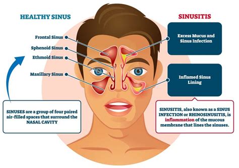 Sinusitis Allergy Asthma Network